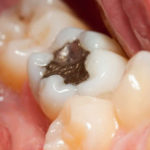 can metal fillings be replaced