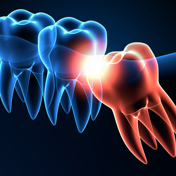 wisdom tooth removal