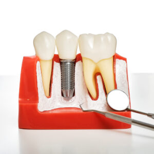 dental implants help other teeth