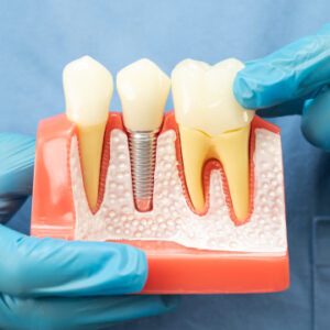 caring for dental implants